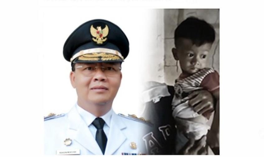 Gubernur dan bayi lahir tanpa anus